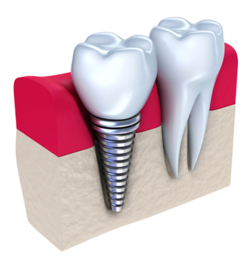 Honeysuckle Dental - Gold Coast Dentists 7