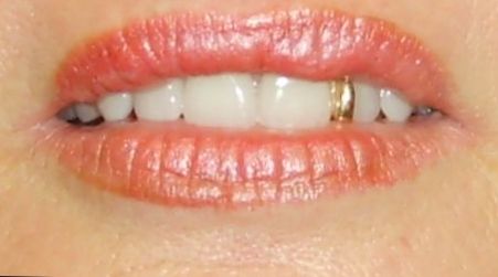 Active Denture Clinic - Gold Coast Dentists 8