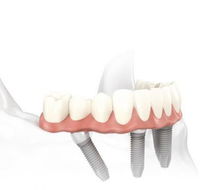 Specialist Oral Surgery - Gold Coast Dentists