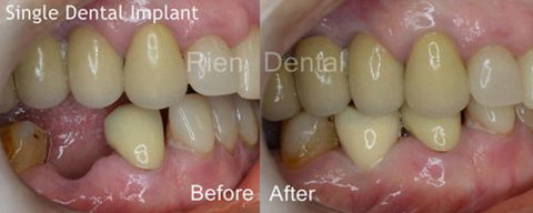 Rien Dental - Gold Coast Dentists 6