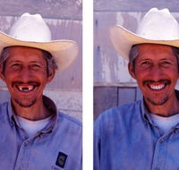 Denture Mt Gravatt - Gold Coast Dentists