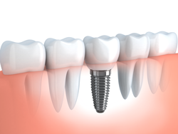 Jones Dental - Gold Coast Dentists 55